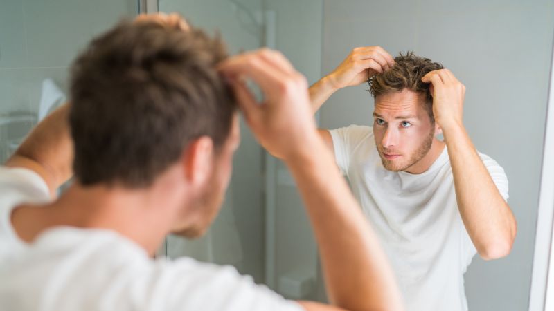 male hair loss