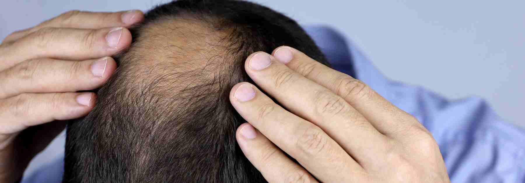 Crown hair loss treatment options. 