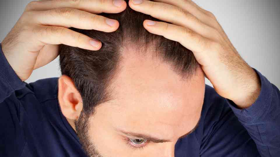 Finasteride before and after 12 months.