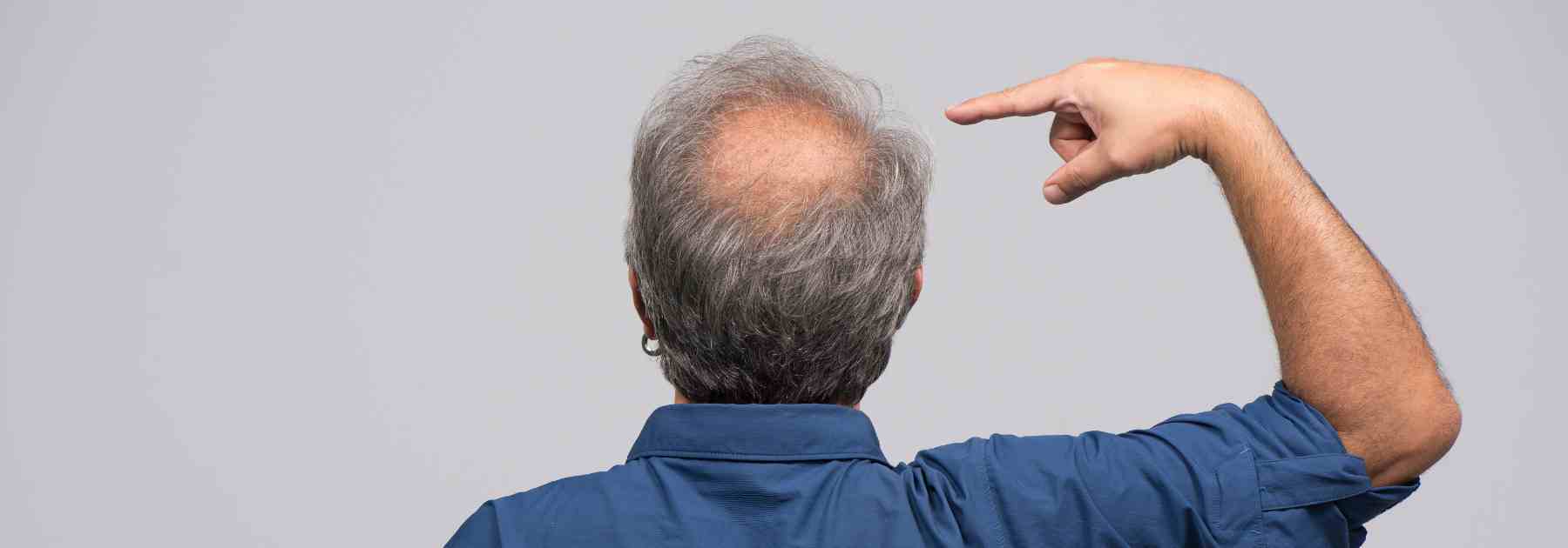 Treat crown hair loss with Simply Meds Direct.