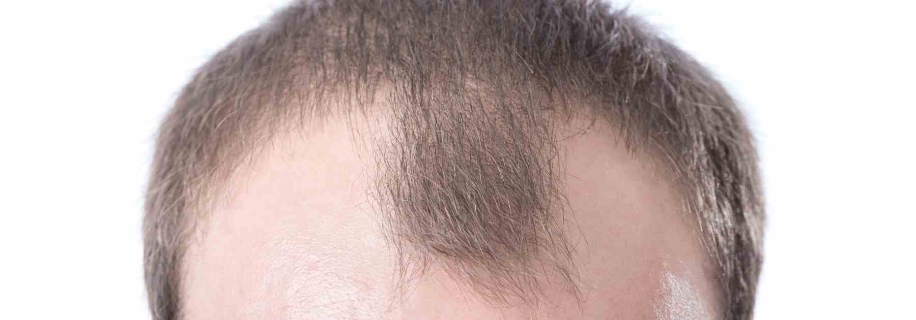 Finasteride before and after expectation.