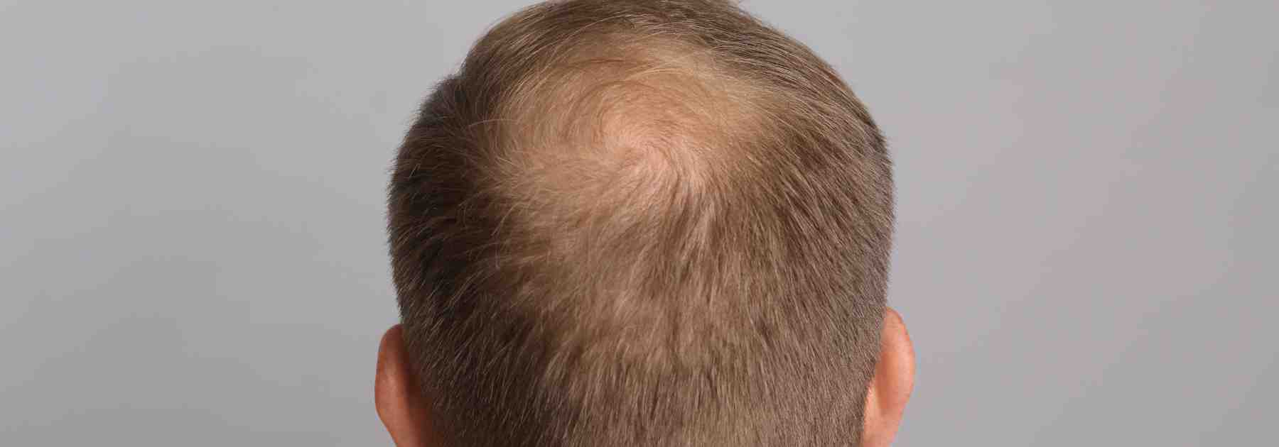 What is a good shampoo for balding?