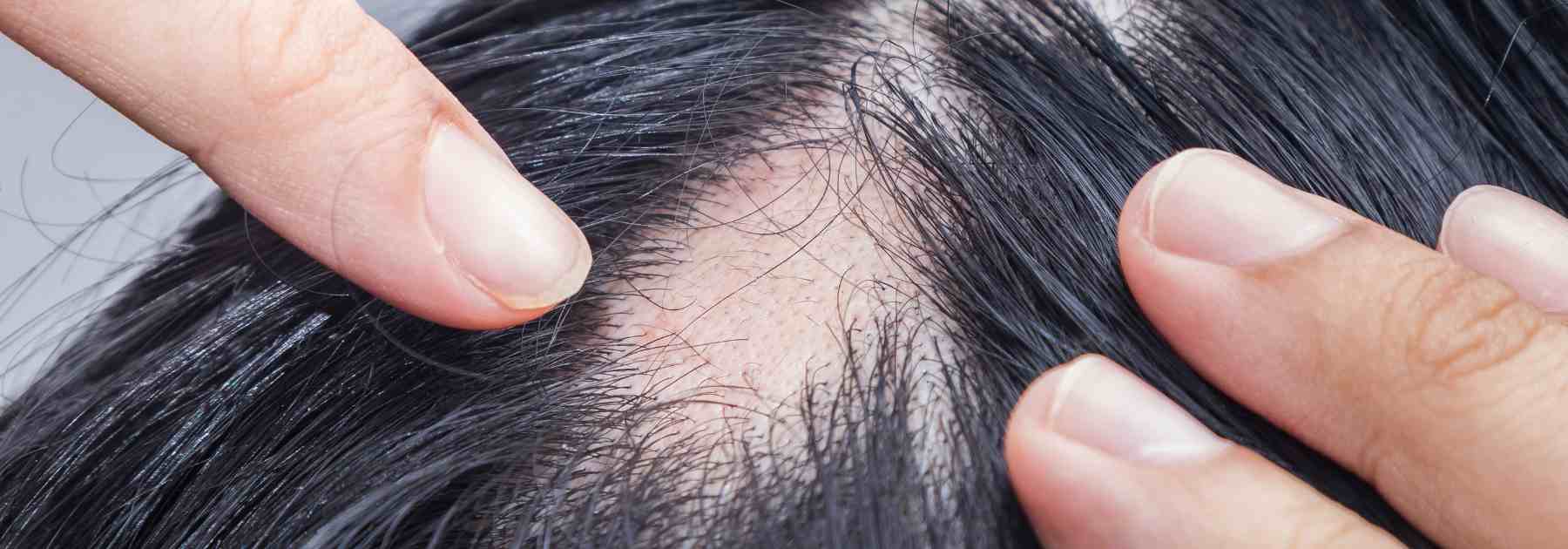 Tablets vs topical finasteride