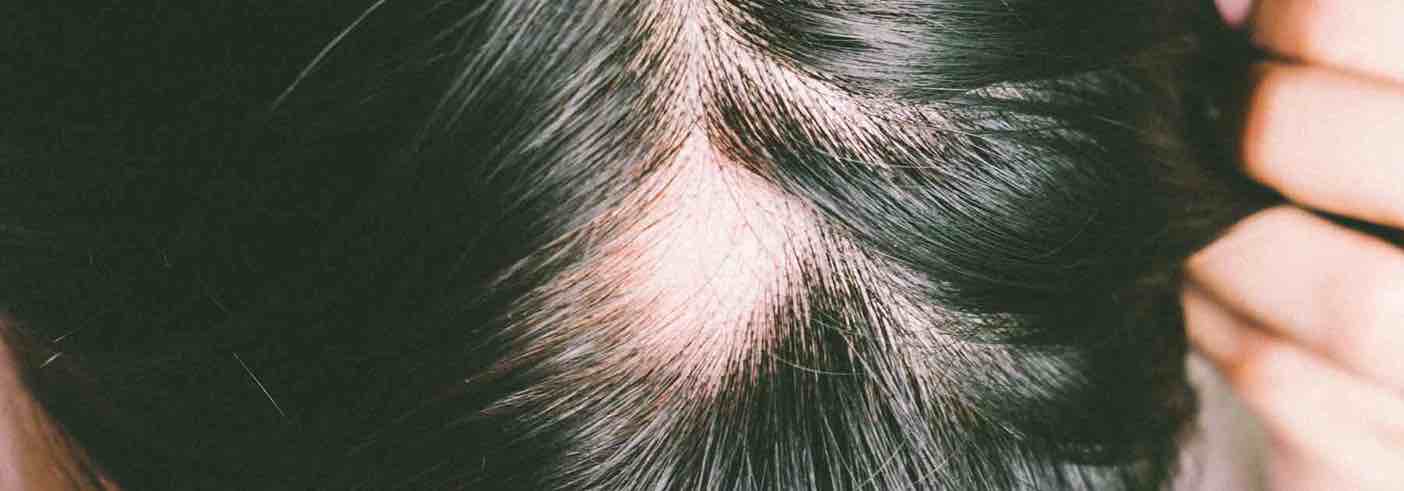Do shampoos for alopecia work?