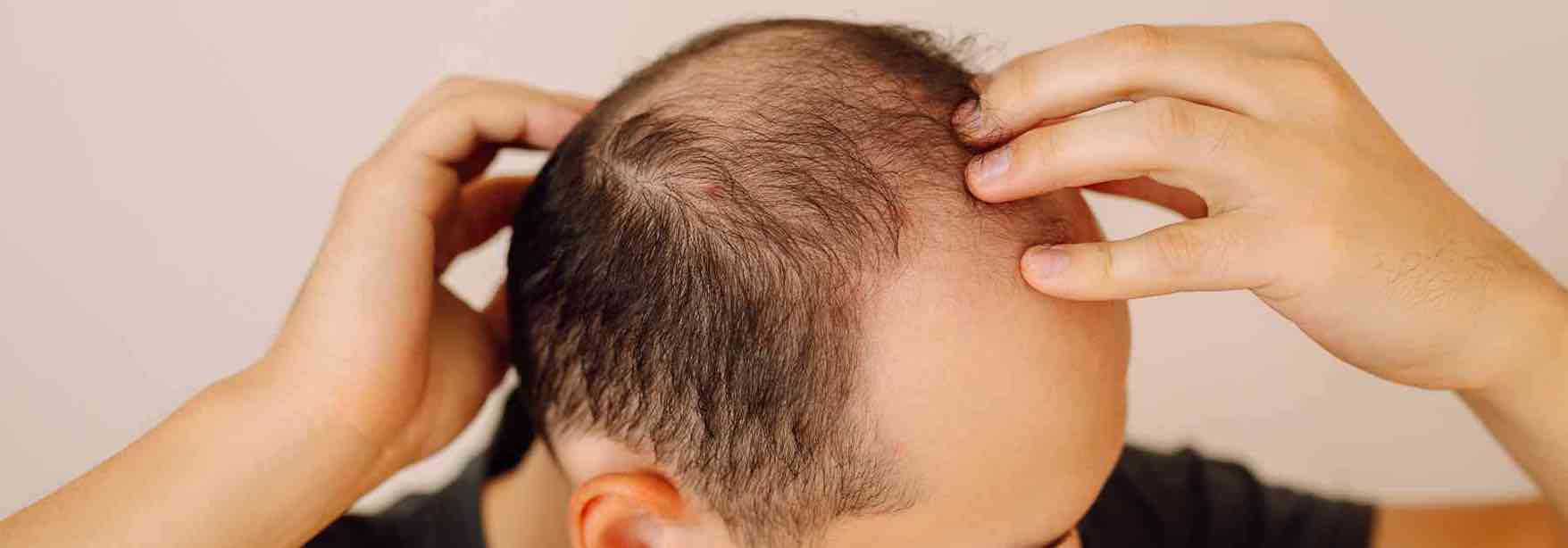 Hair shedding vs hair loss