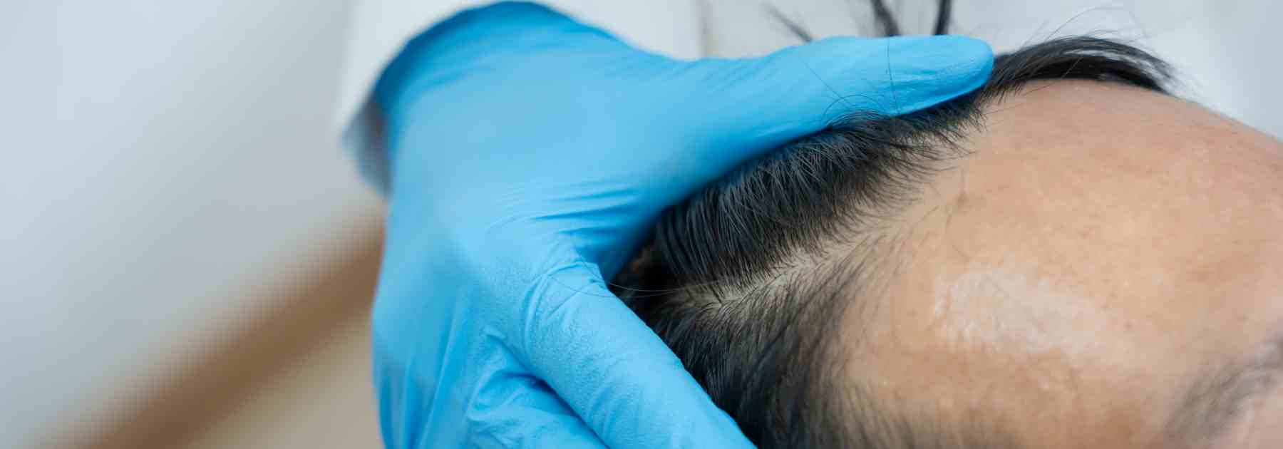 Dutasteride vs Finasteride to stop my receeding hairline