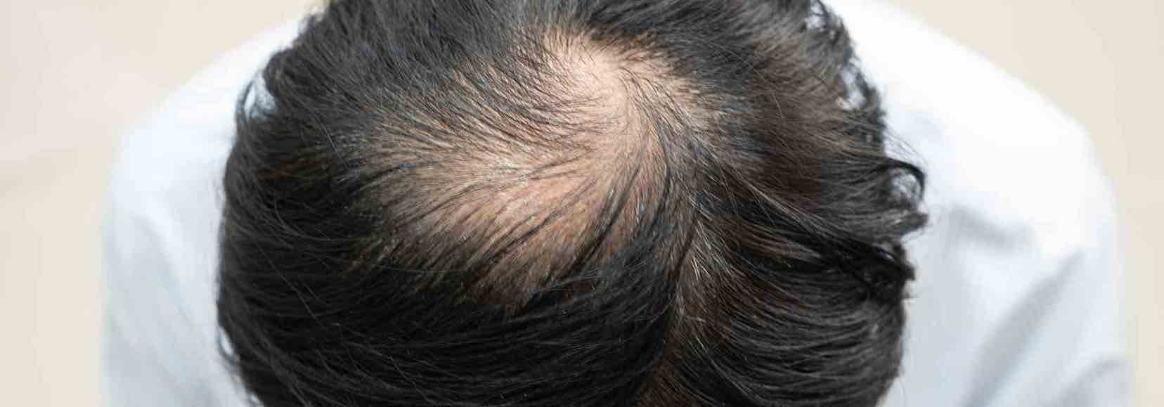 Male hair loss patterns and treatment