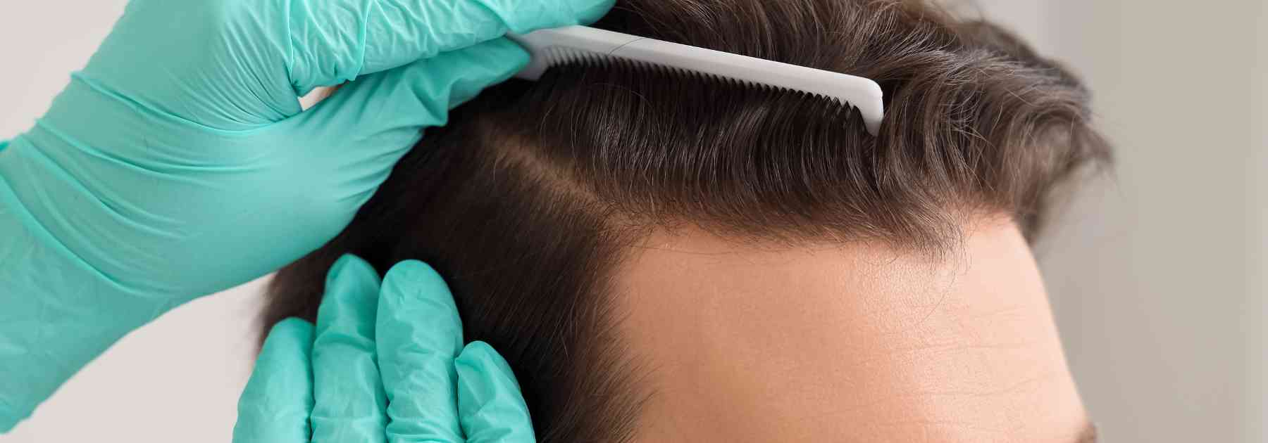 Male pattern hair loss treatment