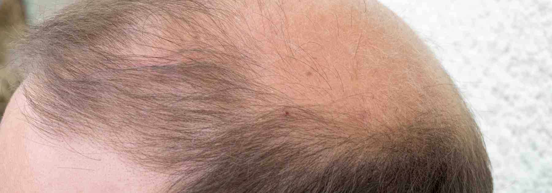 Combat Mounjaro hair loss in men