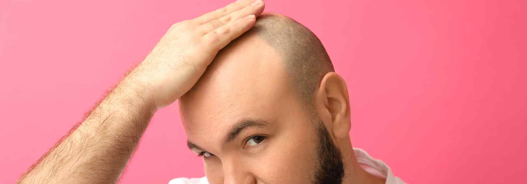 finasteride 5mg hair loss treatment